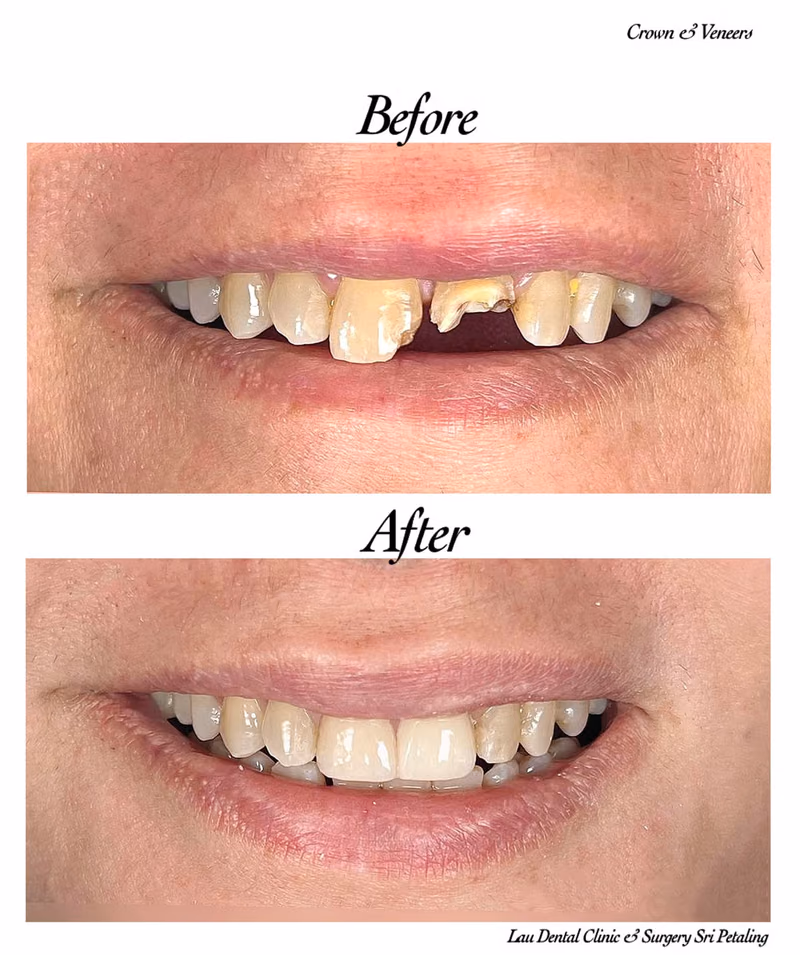 Before and after dental crown restoration showing improved smile aesthetics and tooth alignment.