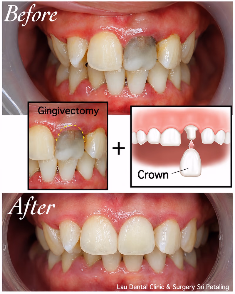 Gingivectomy combined with dental crown treatment correcting a discolored tooth for a natural-looking smile.