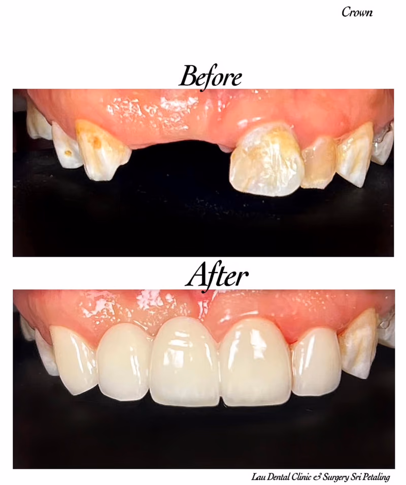Before and after dental crown treatment restoring damaged teeth and improving smile aesthetics.