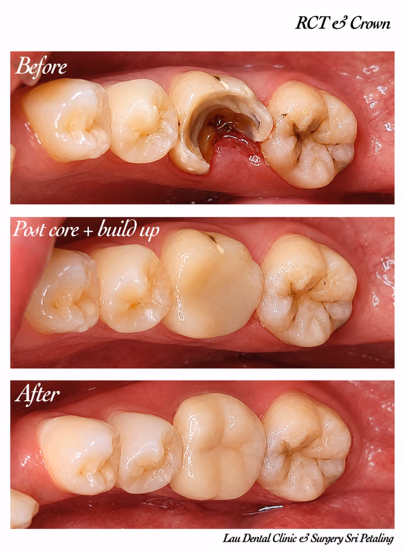Root canal treatment with core build-up and dental crown restoring a fractured molar for long-lasting function.