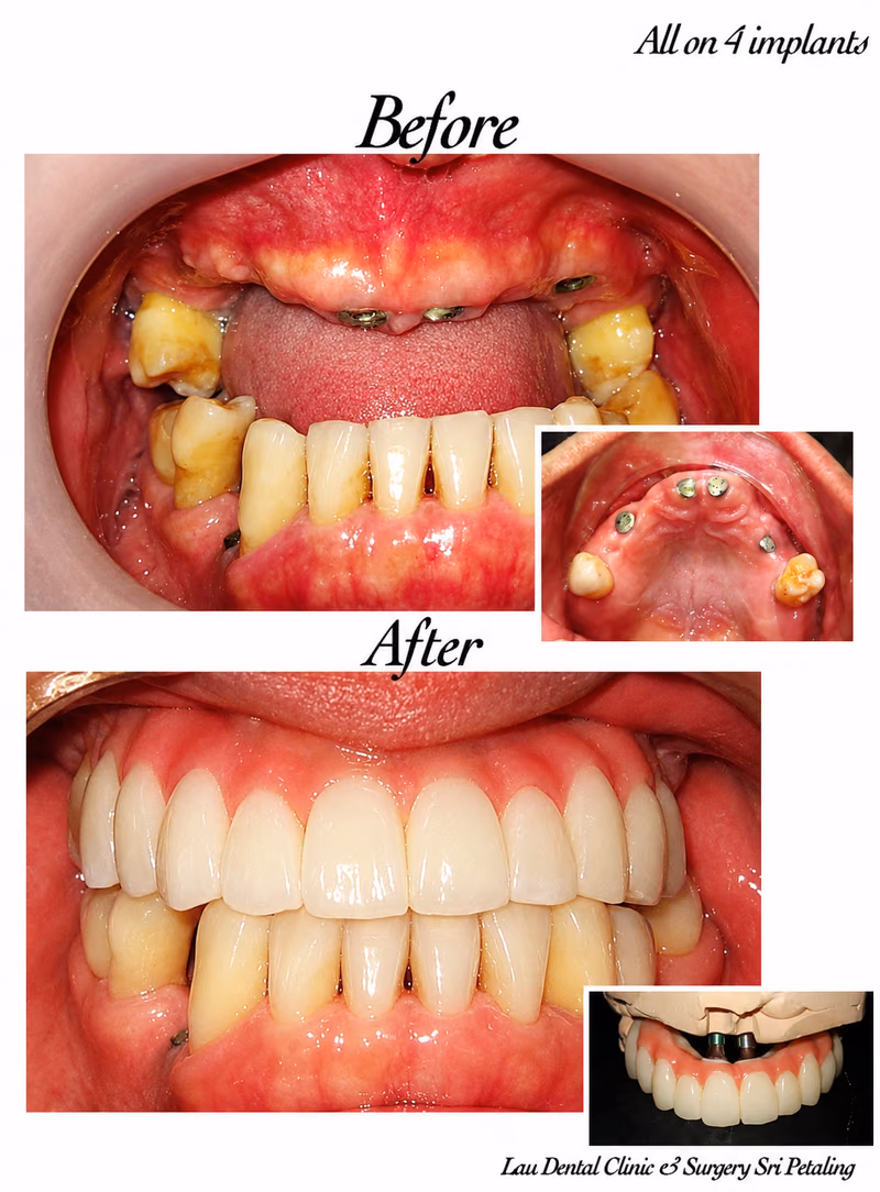 All-on-4 dental implant treatment replacing severely decayed teeth with a full-arch, long-lasting restoration.