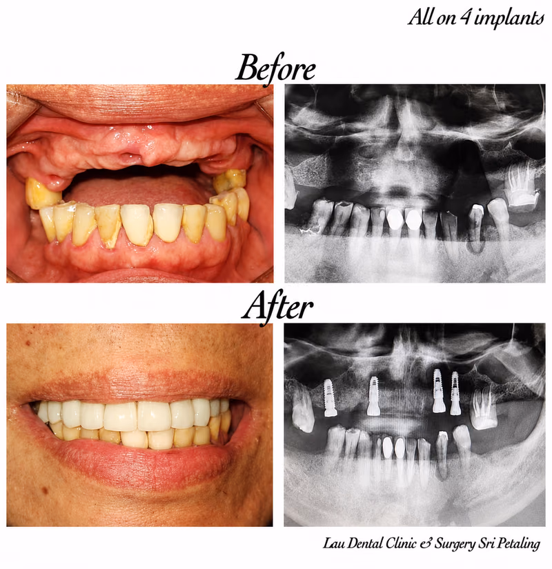 All-on-4 dental implant treatment restoring a fully edentulous arch, shown with x-ray of implant placement.
