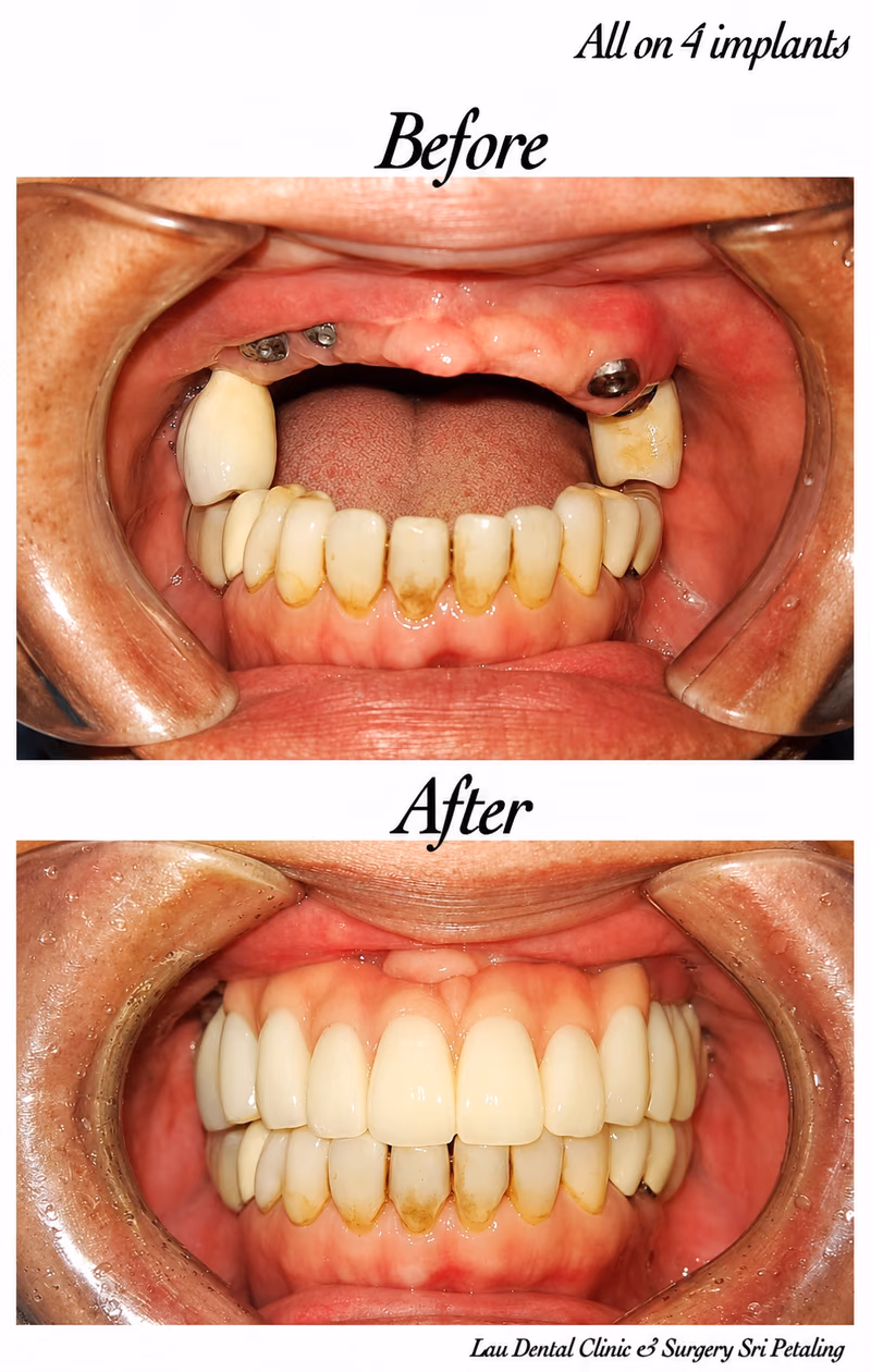 All-on-4 dental implant treatment following full mouth extraction, replacing missing teeth with a fixed smile.