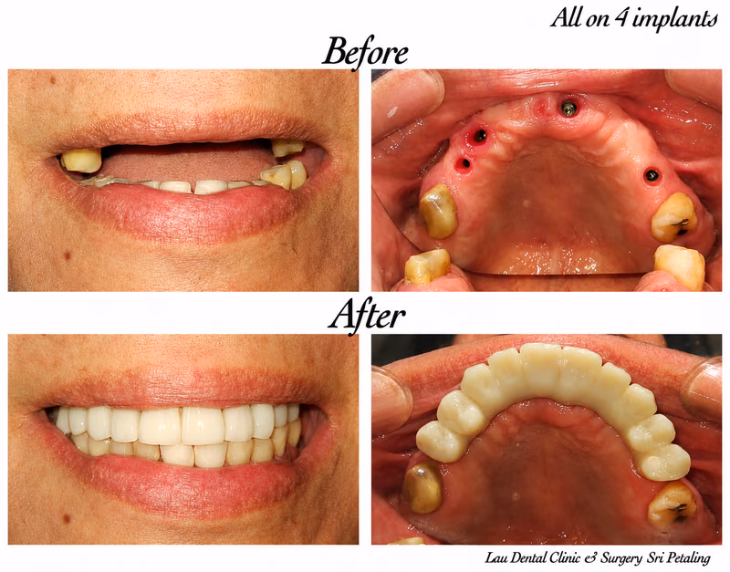 All-on-4 dental implant treatment replacing missing front teeth, rebuilding a complete and confident smile.