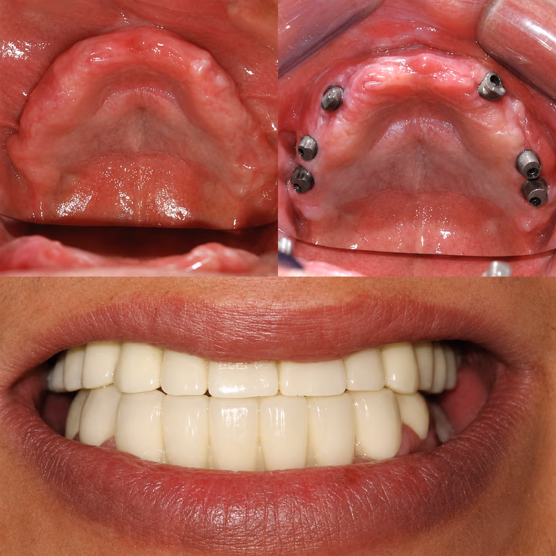 All-on-4 dental implant treatment restoring the upper arch for improved dental function and a natural smile.