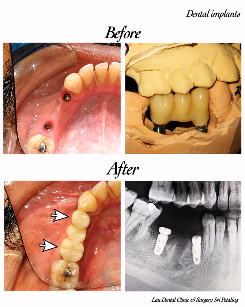 Dental implant treatment restoring missing teeth in the gum area for stronger tooth structure and function.
