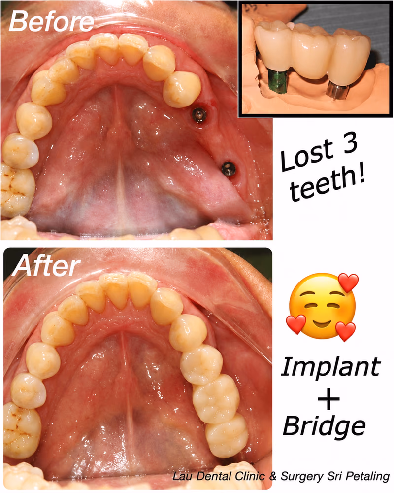 Dental implant and bridge treatment replacing teeth lost from the upper arch, restoring a complete smile.