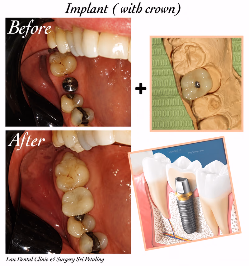Dental implant with custom crown replacing a damaged molar tooth, restoring natural chewing function.