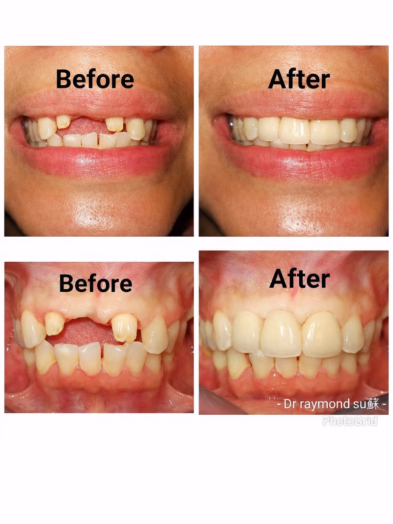 Dental implant treatment closing gaps from missing front teeth, restoring a natural and confident smile.
