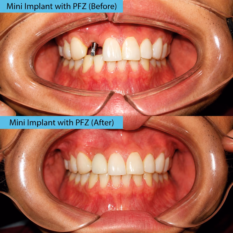 Mini dental implant with PFZ crown replacing a missing front tooth for a natural-looking smile result.