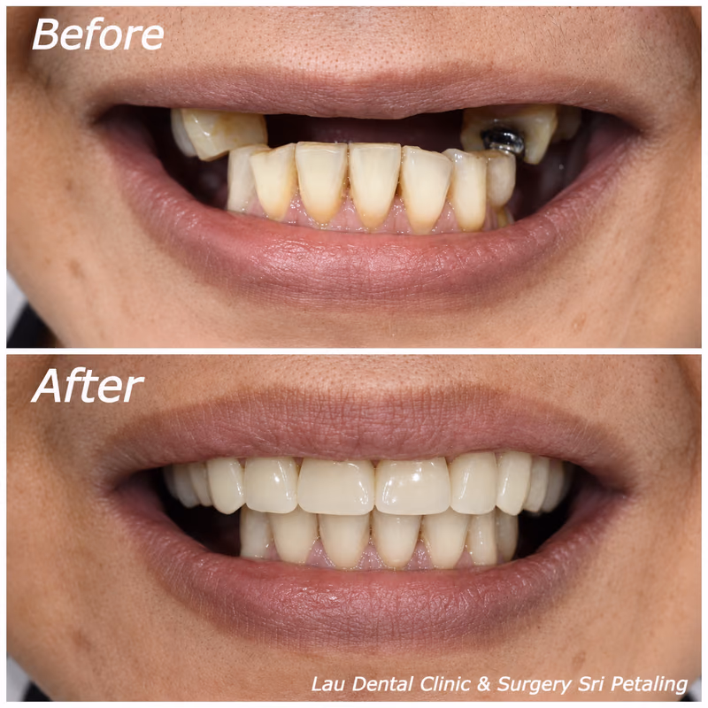 Dental implant treatment replacing multiple missing front teeth for an enhanced, more confident smile.