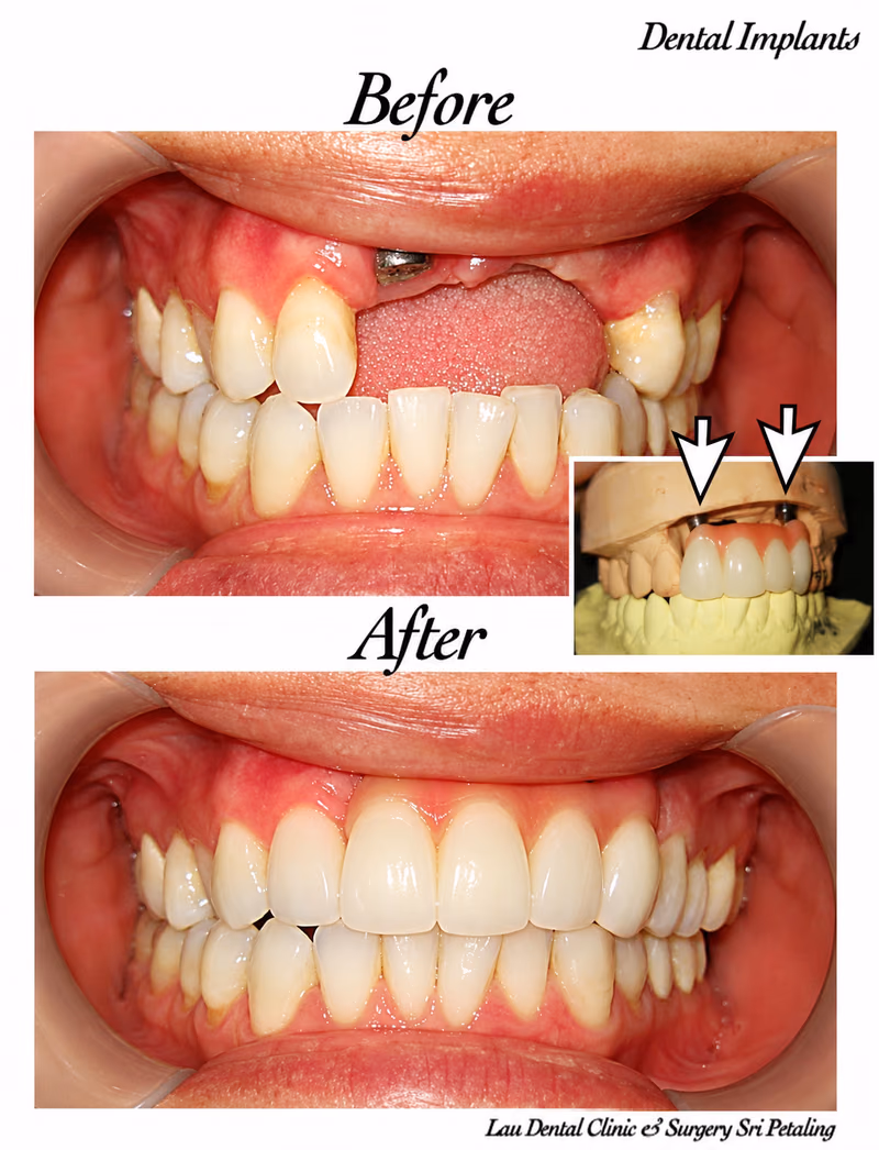Dental implant treatment replacing a missing front tooth, restoring a natural-looking, balanced smile.