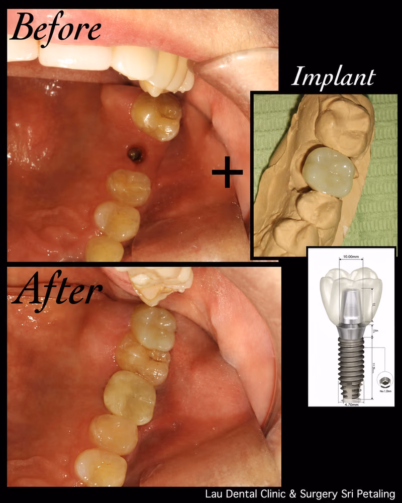 Dental implant treatment replacing a missing molar tooth, restoring chewing strength and dental function long-term.