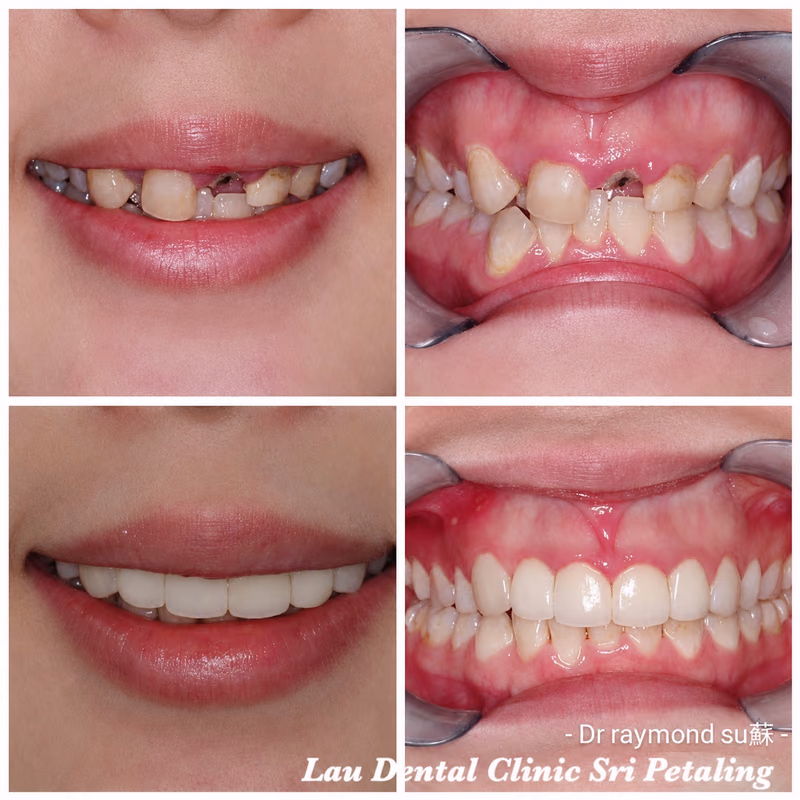 Dental implant treatment replacing multiple missing front teeth, shown with full smile and intraoral views.
