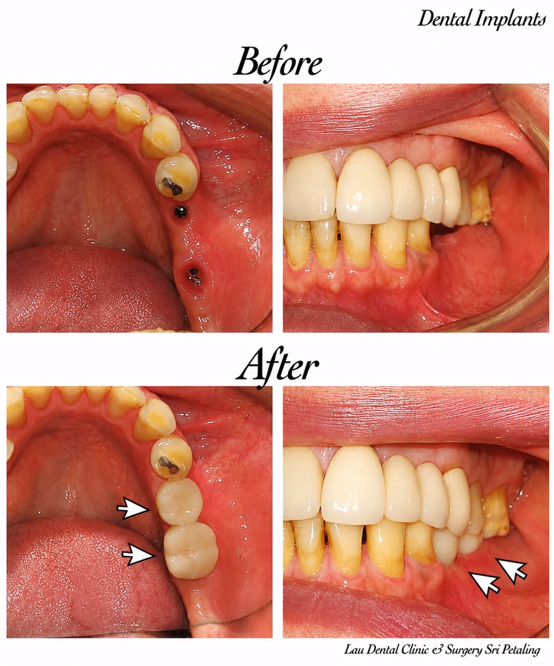 Side view of dental implant treatment replacing multiple missing back teeth, restoring bite alignment.