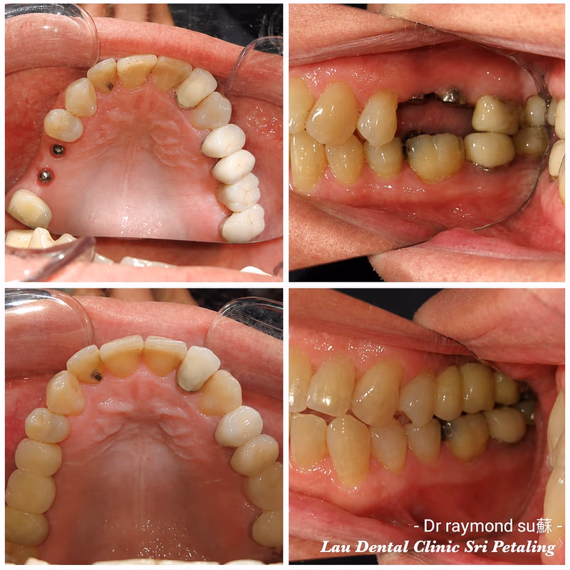 Dental implant treatment replacing a missing premolar tooth, restoring dental function and bite alignment.
