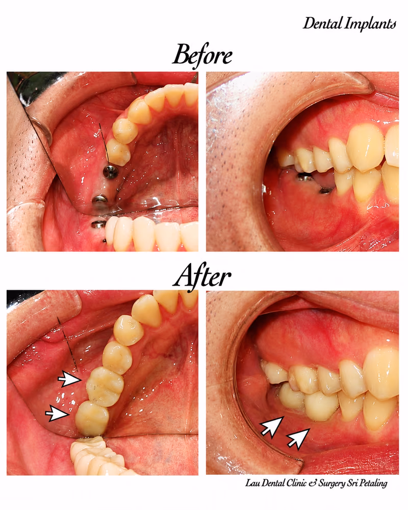 Side view of dental implant treatment showing healthy gum healing and replacement of missing back teeth.