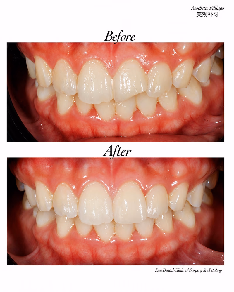 Before and after aesthetic dental filling treatment correcting uneven front teeth and improving smile appearance.