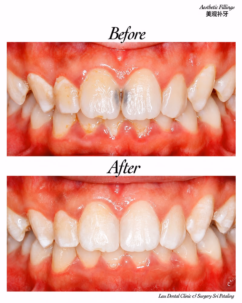 Before and after aesthetic filling treatment repairing front tooth gaps and restoring a more even smile.