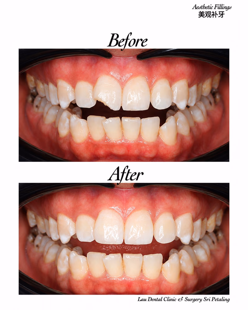 Aesthetic dental filling before and after treatment repairing chipped front teeth for a natural smile.