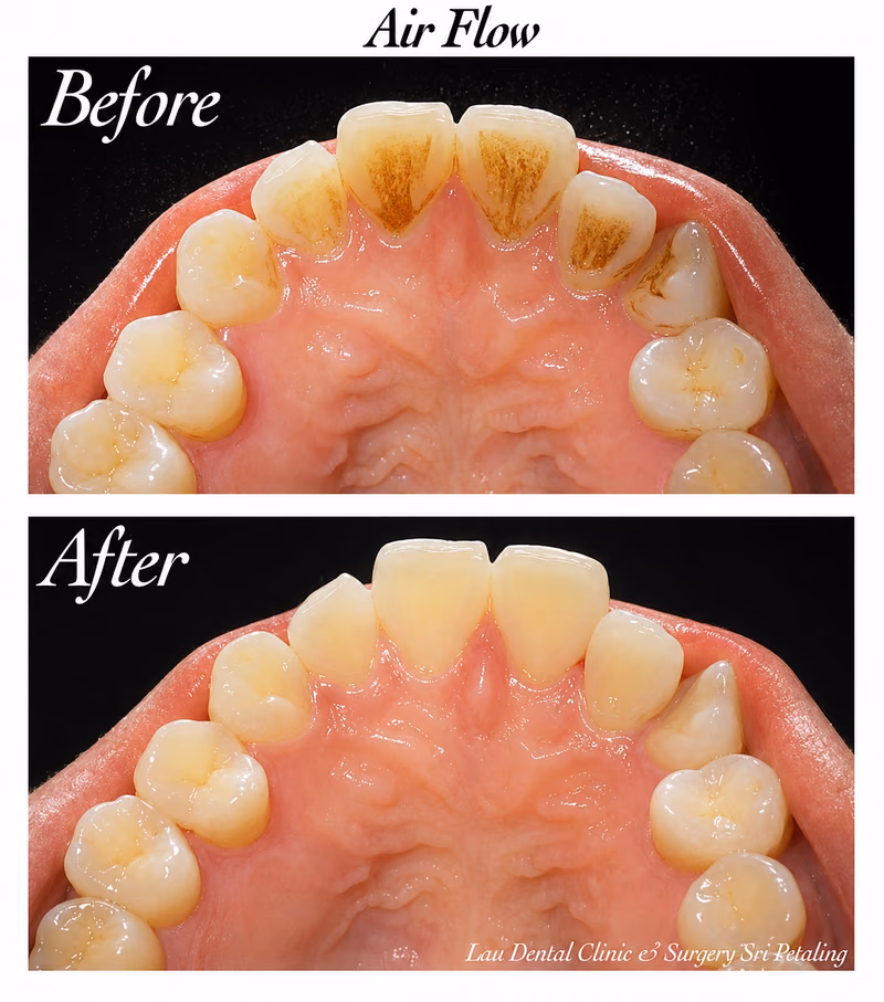 Air Flow stain removal treatment clearing surface staining from the upper front teeth for a cleaner smile.