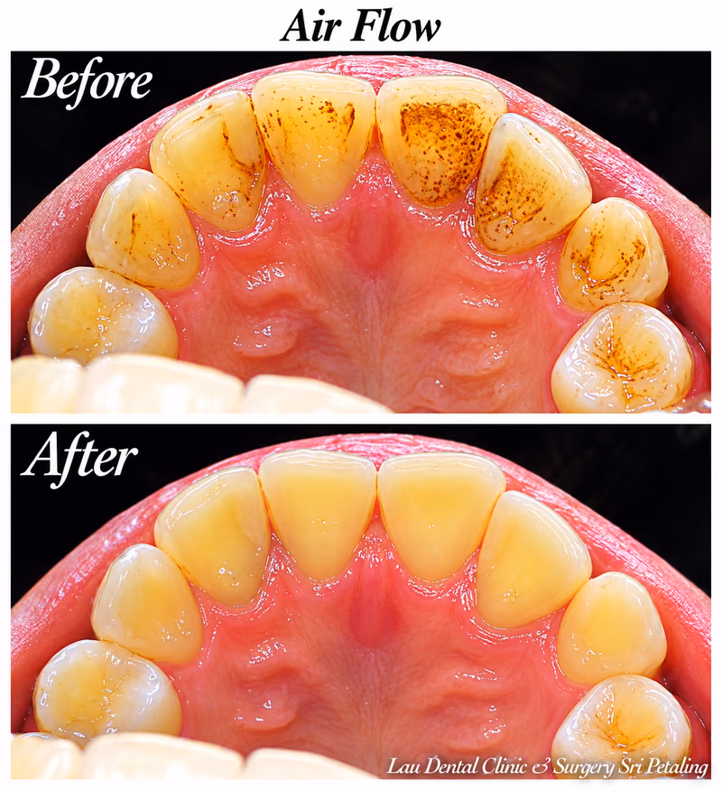 Air Flow stain removal treatment clearing speckled surface stains from the upper front teeth for a cleaner smile.
