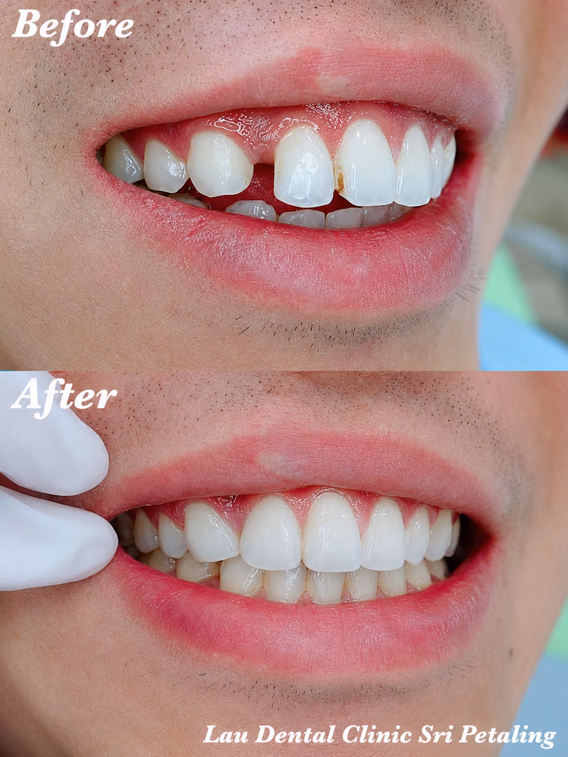Composite filling repairing a chipped front tooth, restoring natural tooth shape and smile confidence.