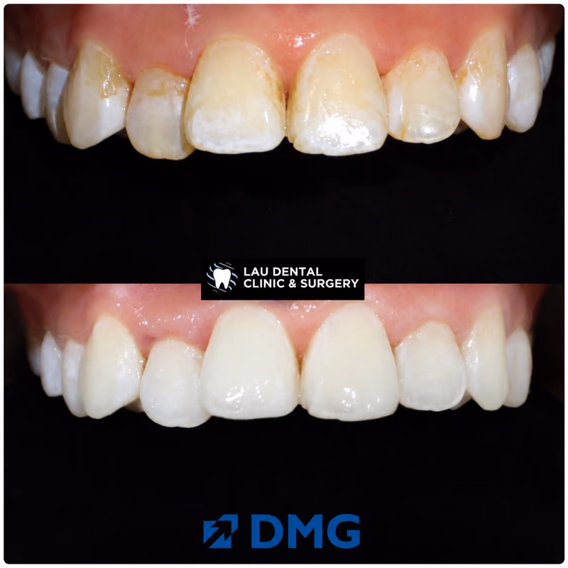 Composite filling treatment restoring discolored front teeth for a brighter, more natural-looking smile.