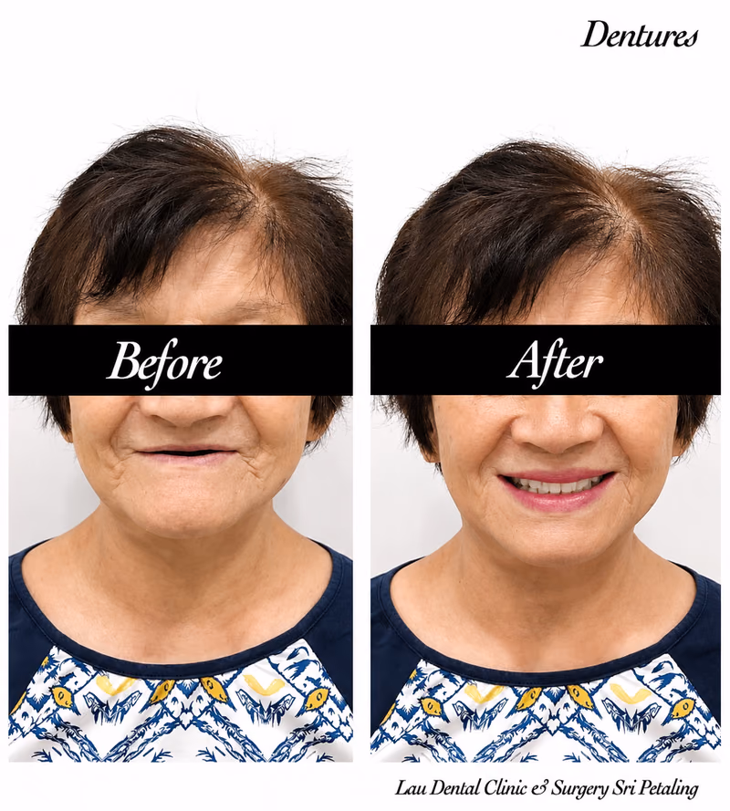 Denture treatment replacing missing teeth, restoring facial support and a more natural, confident smile.