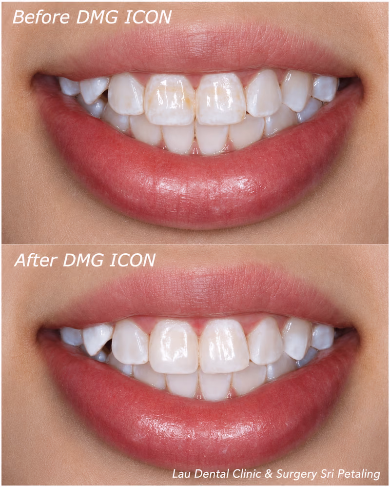 DMG ICON infiltration treatment reducing brown and white spot discoloration on the front teeth for a brighter smile.