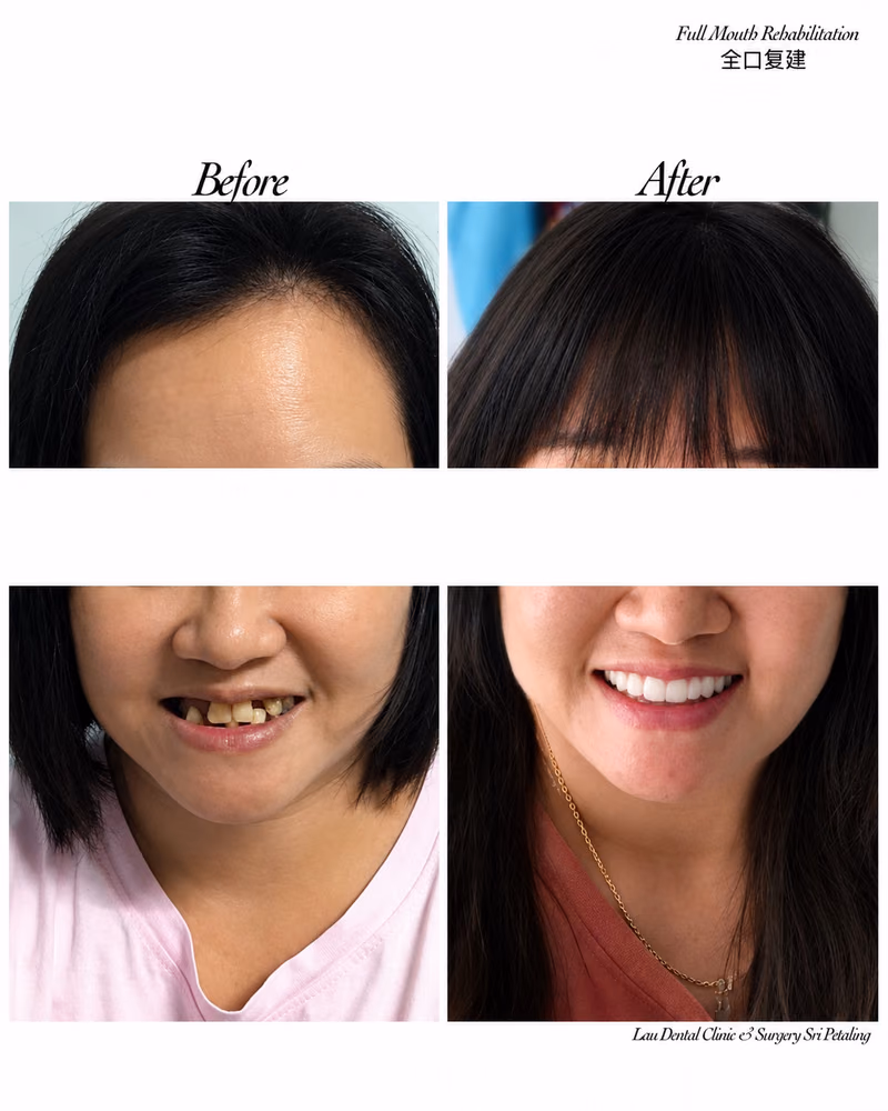 Full mouth rehabilitation before and after restoring missing teeth and smile aesthetics.
