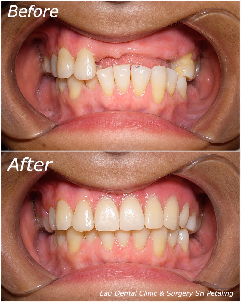 Full mouth rehabilitation restoring severely decayed teeth for improved dental function and appearance.