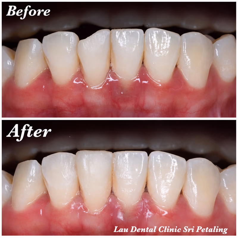 General dental treatment improving gum health around the lower front teeth for a healthier, even smile.