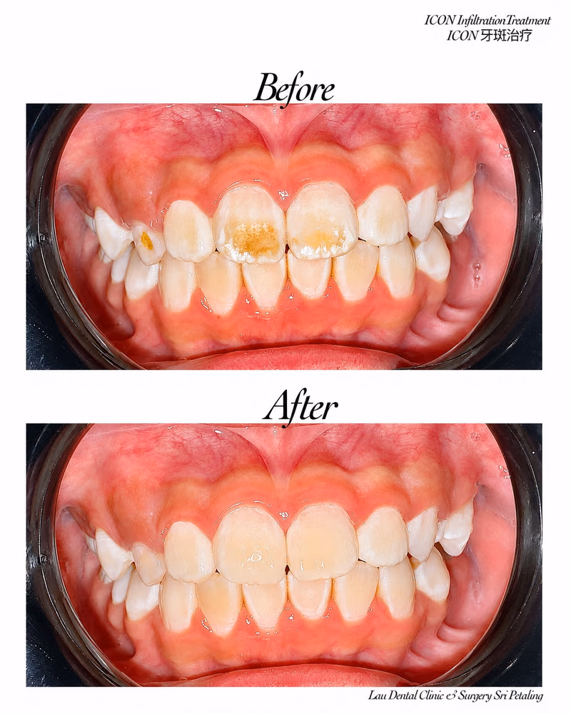 ICON infiltration treatment before and after reducing white spot lesions on front teeth.