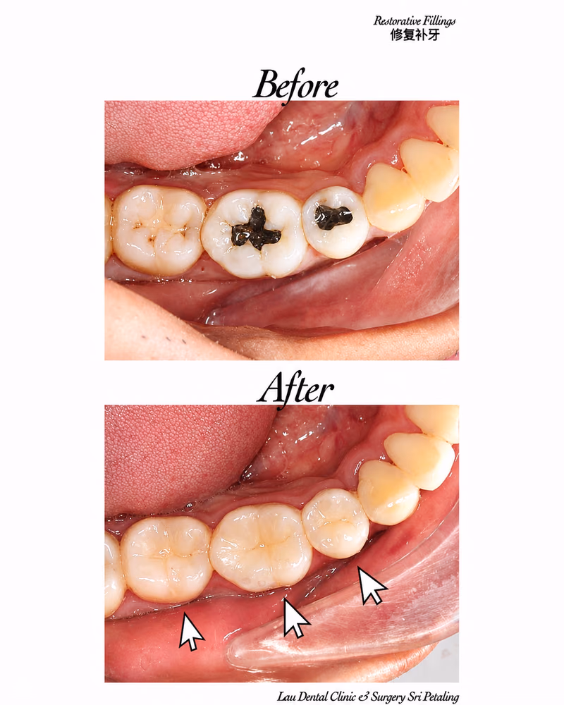 Before and after restorative fillings repairing decayed teeth with natural-looking results.