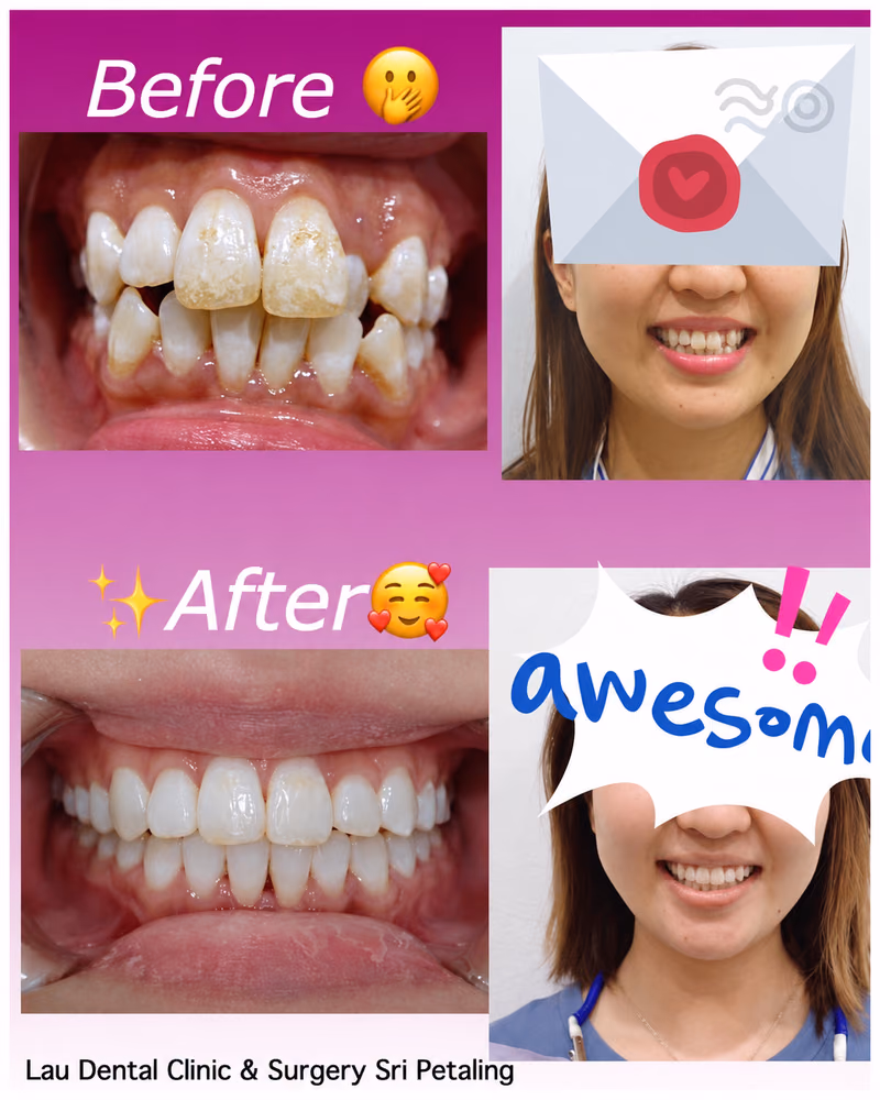 Scaling and polishing treatment removing surface stains from teeth, restoring a brighter, healthier smile.