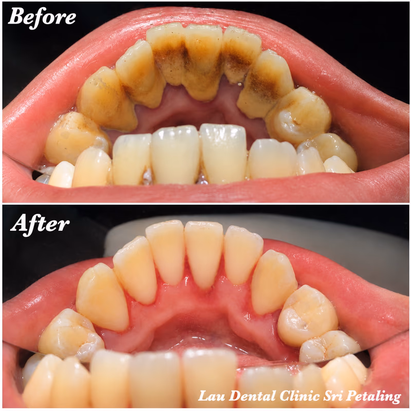 Scaling and polishing treatment removing tartar buildup from the lower teeth for improved oral hygiene.