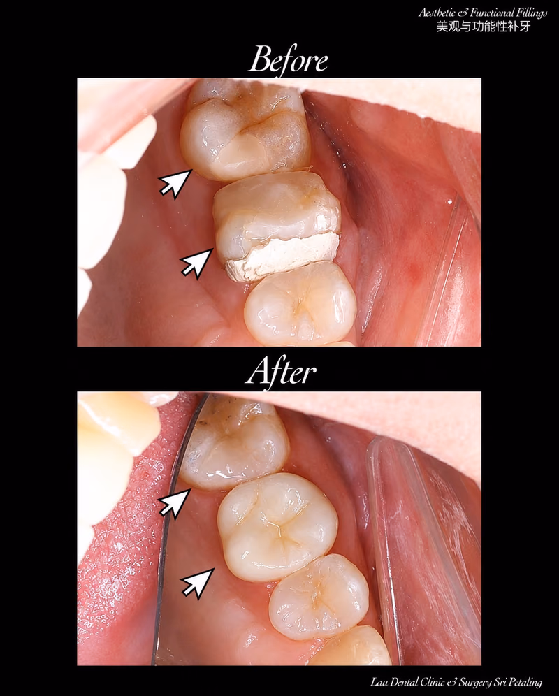 Before and after aesthetic tooth filling restoring damaged molars with natural-looking results.