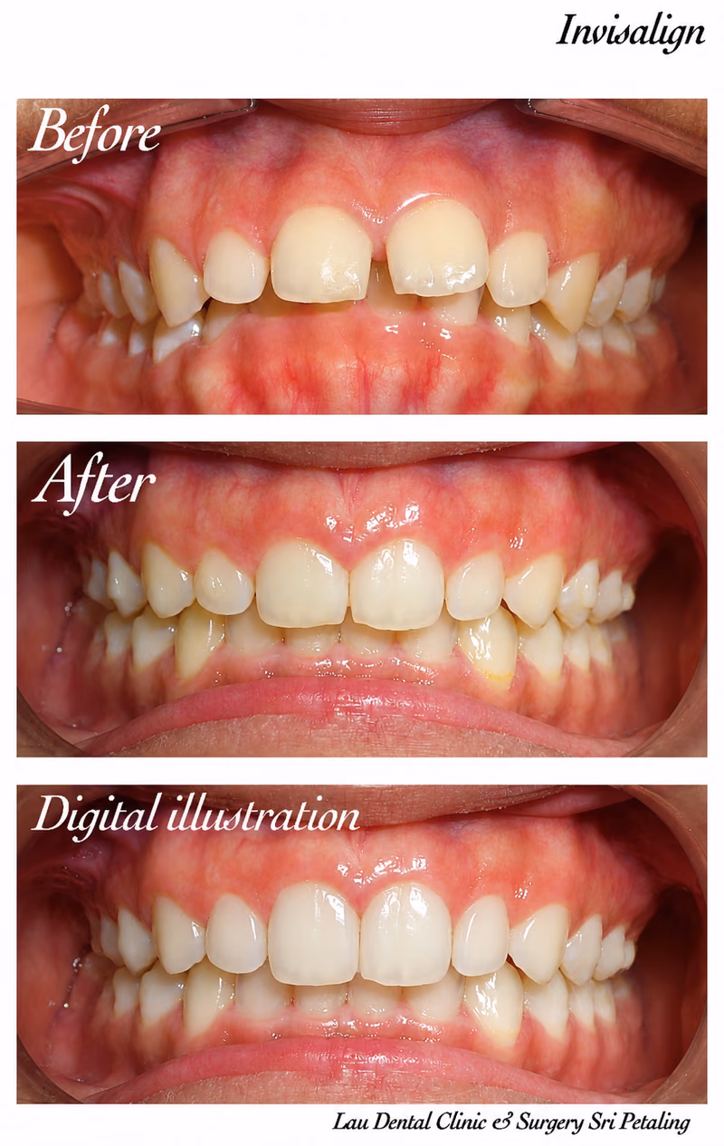 Invisalign treatment aligning crowded front teeth, including a chipped tooth, for a natural-looking smile.