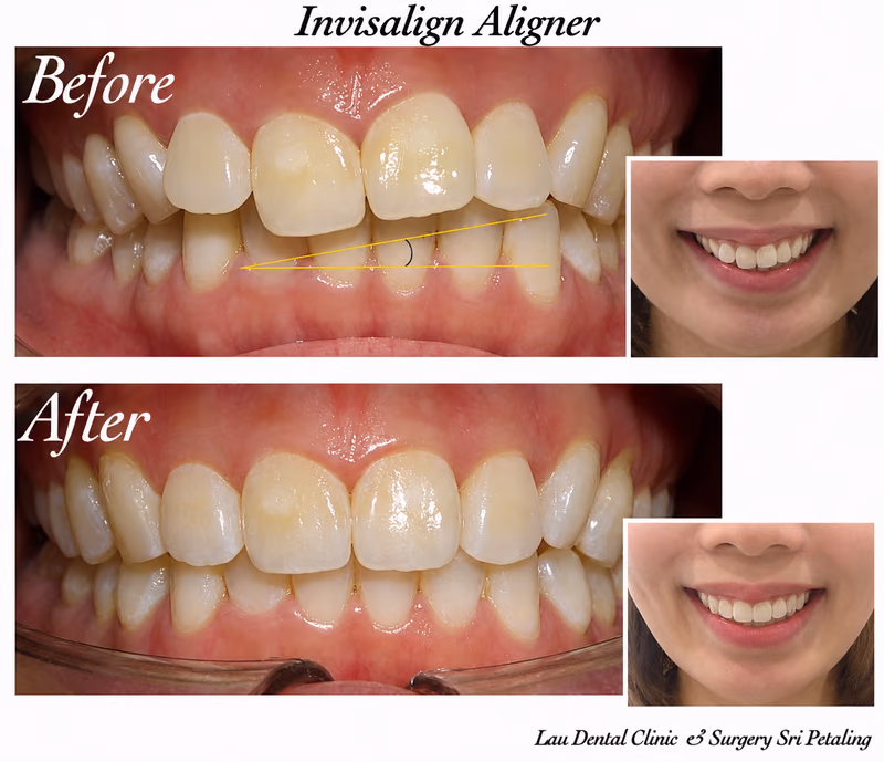Invisalign clear aligner treatment correcting a crossbite for improved bite alignment and smile confidence.