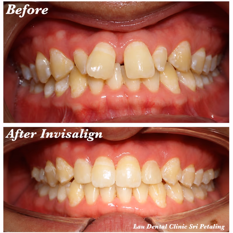 Invisalign before and after treatment straightening crowded lower teeth for improved dental function.