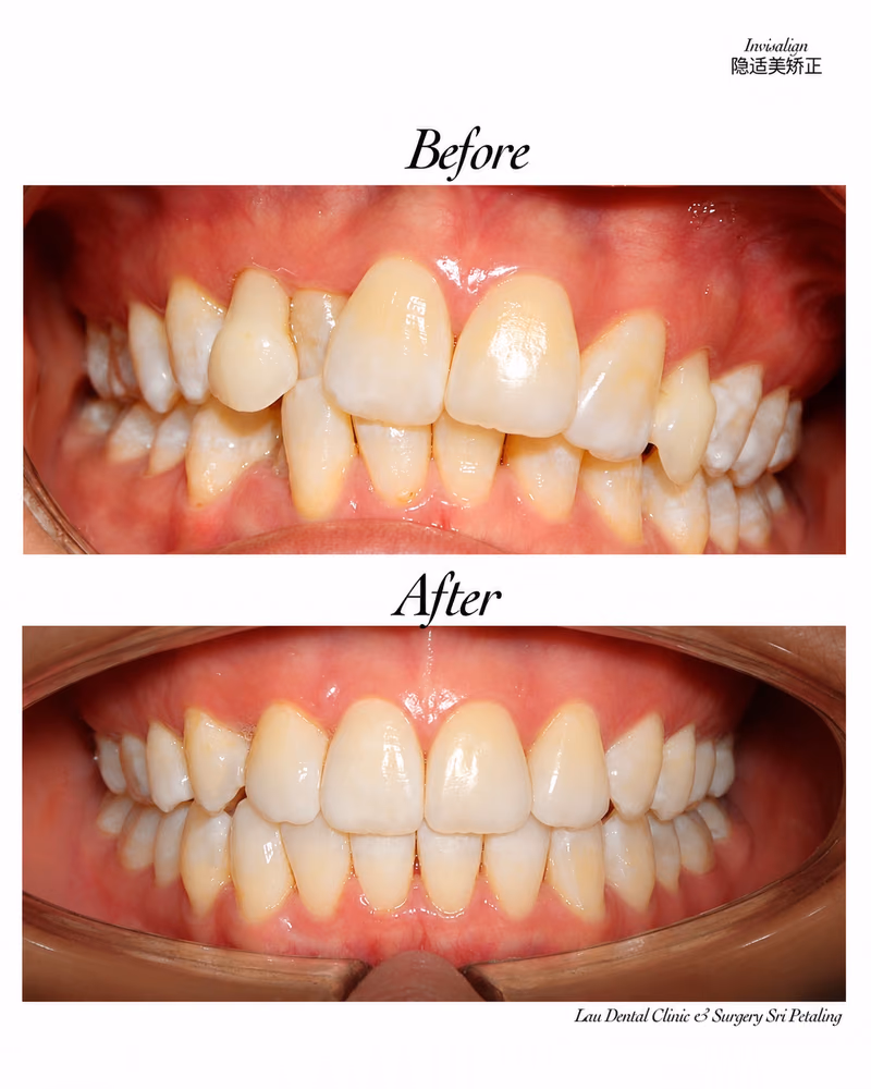 Invisalign before and after treatment correcting crowded teeth and improving smile alignment.
