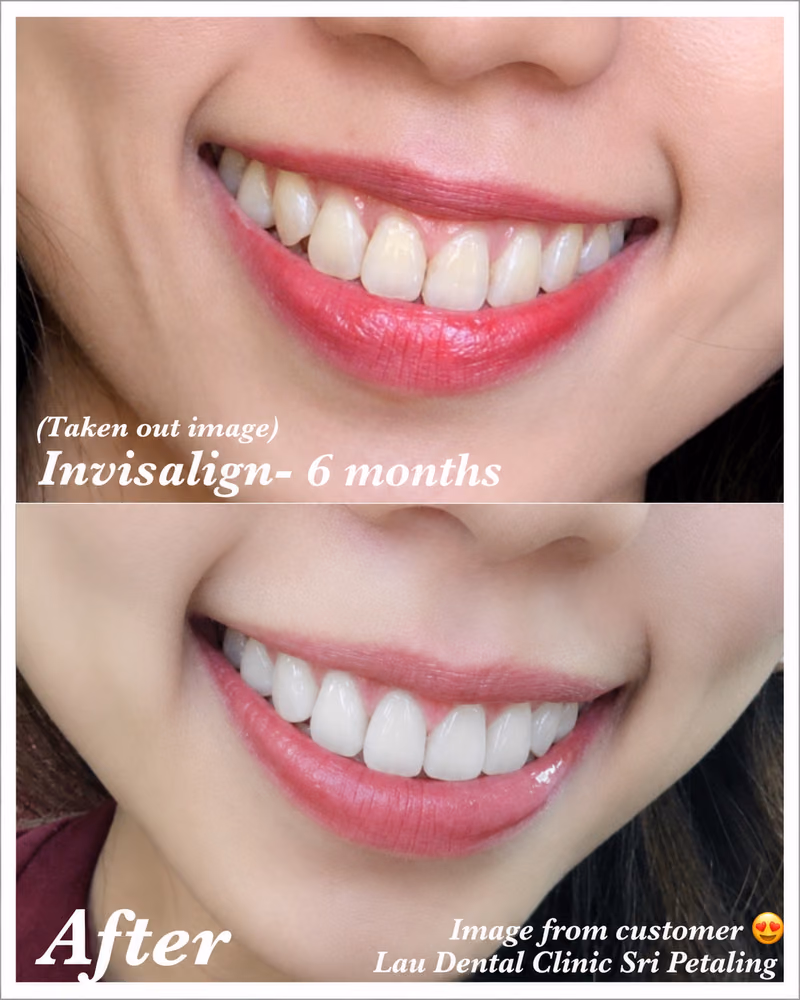 Invisalign clear aligner treatment improving tooth alignment alongside a brighter, more even tooth shade.