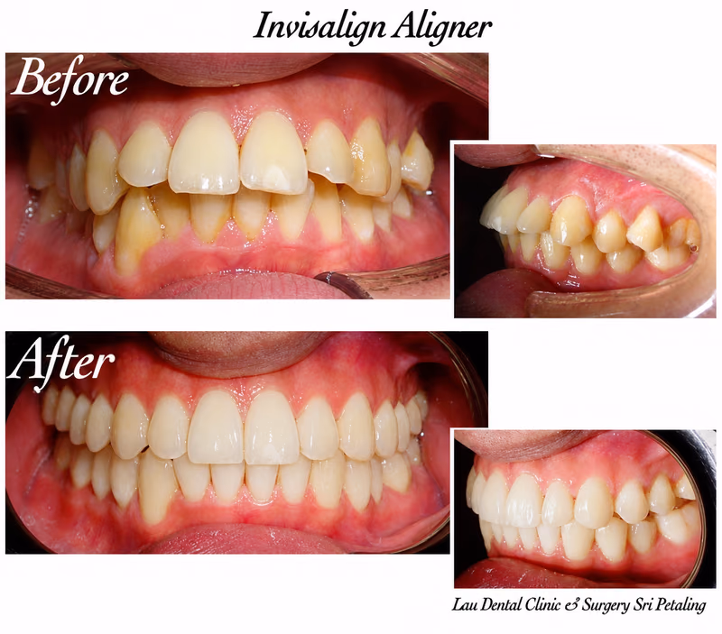 Invisalign before and after treatment closing gaps between front teeth for improved smile aesthetics.