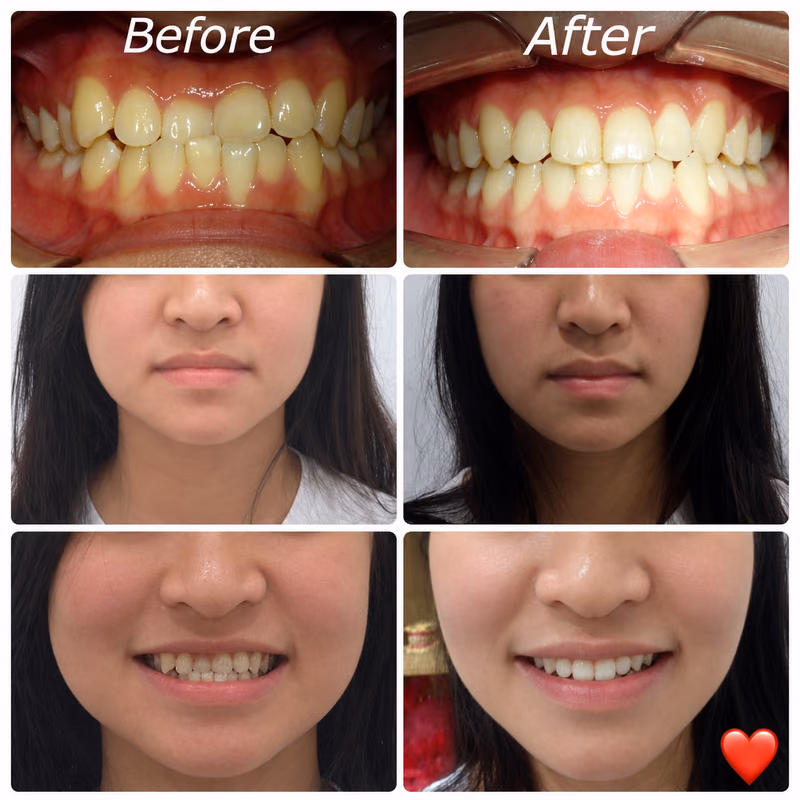 Invisalign treatment correcting an overbite and front tooth crowding for a more balanced, natural-looking smile.