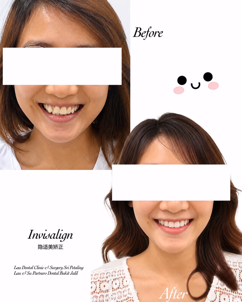 Invisalign before and after treatment improving teeth alignment and smile confidence.