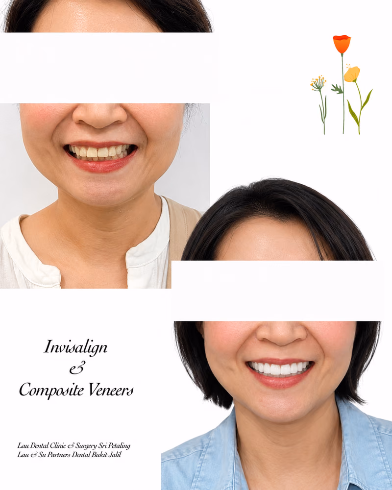 Invisalign and composite veneers before and after treatment creating a straighter, brighter smile.