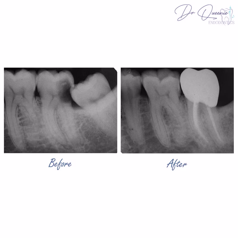 Before and after root canal treatment restoring a severely decayed and damaged tooth