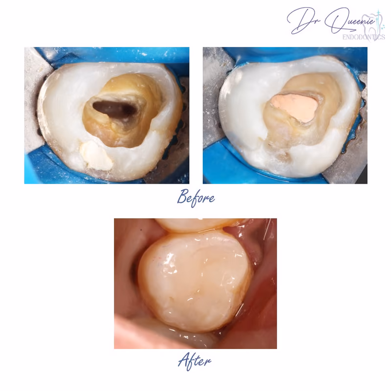 Before and after root canal treatment showing restoration of a severely damaged tooth