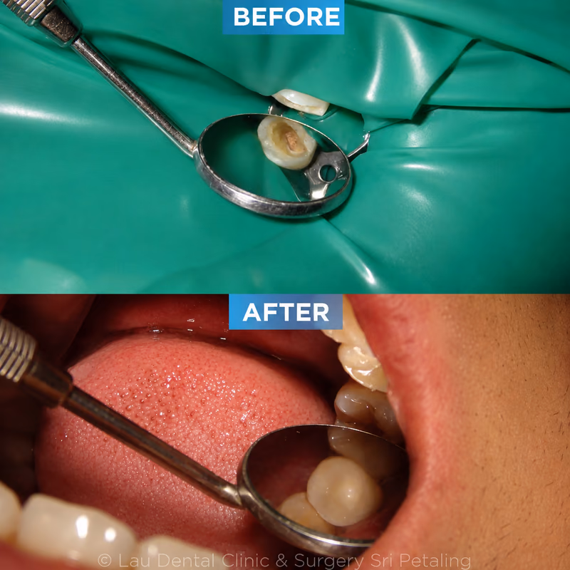 Root canal treatment on a decayed molar under rubber dam isolation, restoring the tooth back into healthy function.